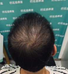 -碧莲盛·不剃发植发