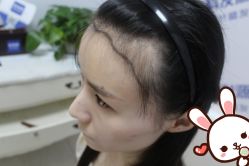 -大麦微针植发丨全国连锁