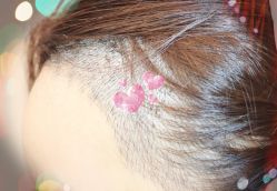 -大麦微针植发全国连锁