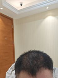 -碧莲盛·不剃发植发