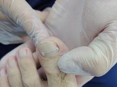 -Andrew指甲专科灰指甲·甲沟炎矫正·3D步态矫形鞋垫定制(浦三路店)