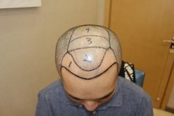 -大麦微针植发丨全国连锁