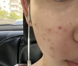 体验前-新雨池不针清祛痘