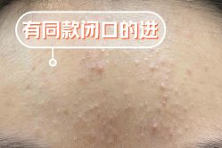-成都苗方清颜专业祛痘