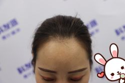 点击看大图 -大麦微针植发丨全国连锁