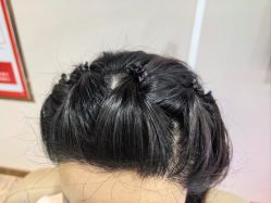 -碧莲盛·不剃发植发