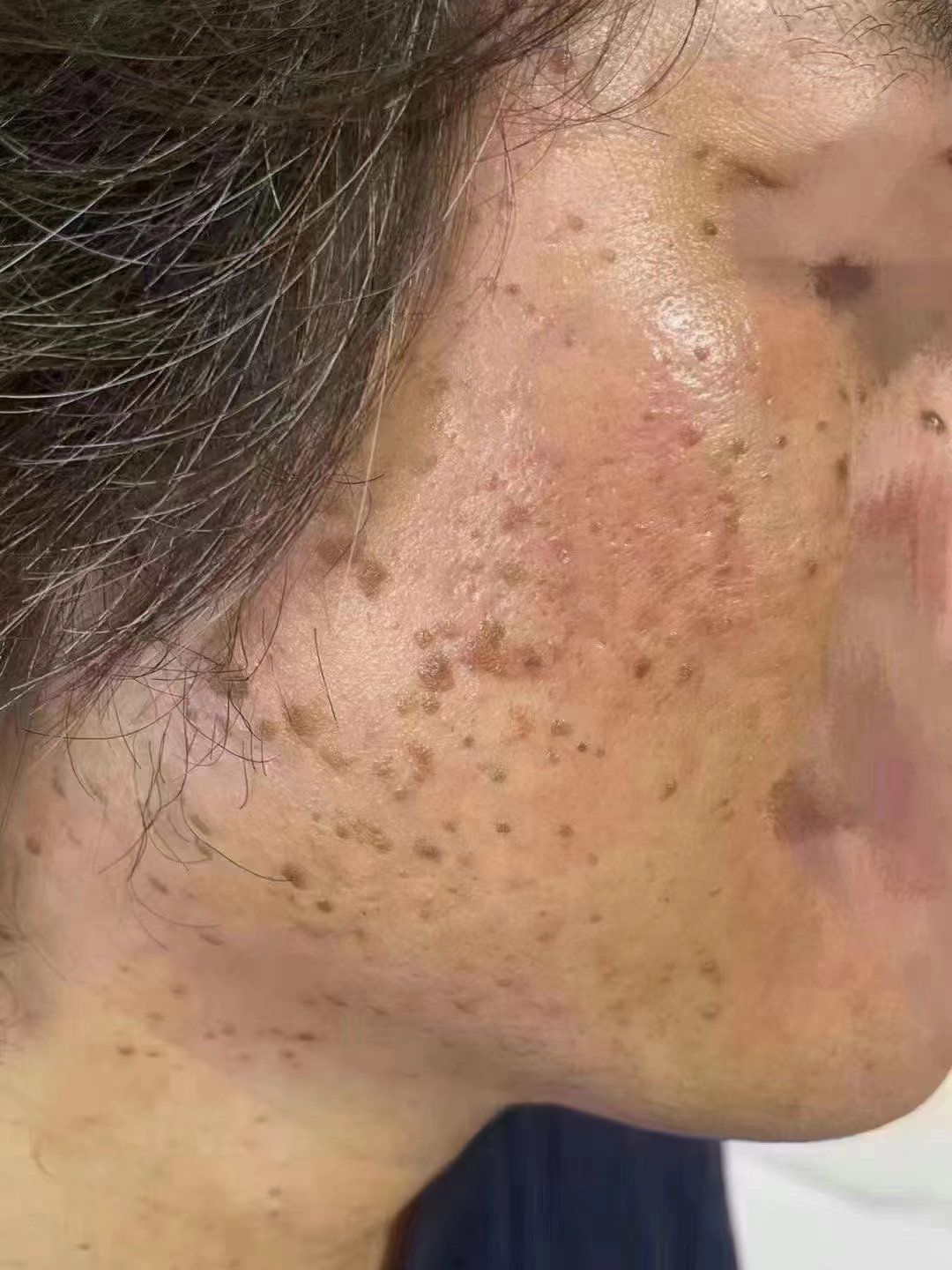 🦠疣
早发现早祛除～
一直告诉