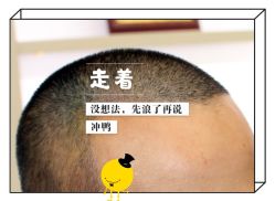 -大麦微针植发全国连锁