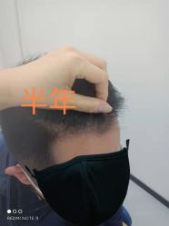 体验前-大麦微针植发全国连锁