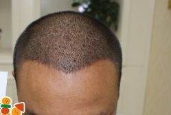 -大麦微针植发丨全国连锁