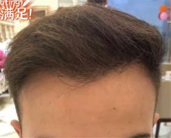 -大麦微针植发全国连锁