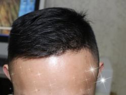 -大麦微针植发全国连锁