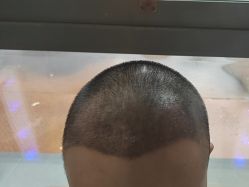 -碧莲盛·不剃发植发