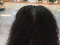 -碧莲盛·不剃发植发