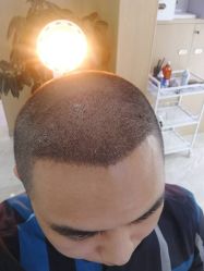 点击看大图 -大麦微针植发丨全国连锁