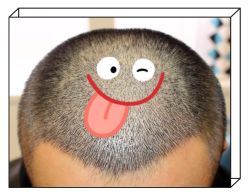 -大麦微针植发全国连锁