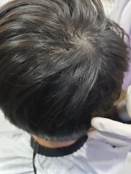 -碧莲盛不剃发植发