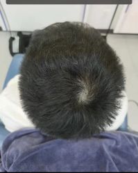 -大麦微针植发全国连锁