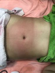 -苗塑堂减肥艾灸
