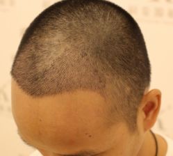 -大麦微针植发全国连锁