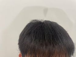 -碧莲盛·不剃发植发