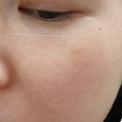 体验后-上海首尔丽格医疗美容医院