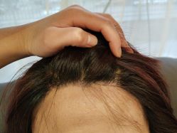 -碧莲盛·不剃发植发