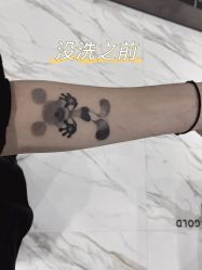 手部-一次性洗纹身·修复疤痕·超皮秒