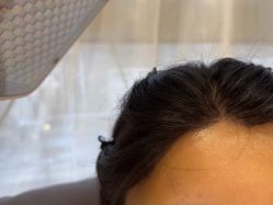 -碧莲盛·不剃发植发