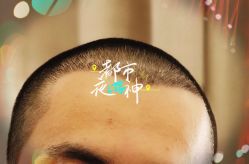-大麦微针植发全国连锁