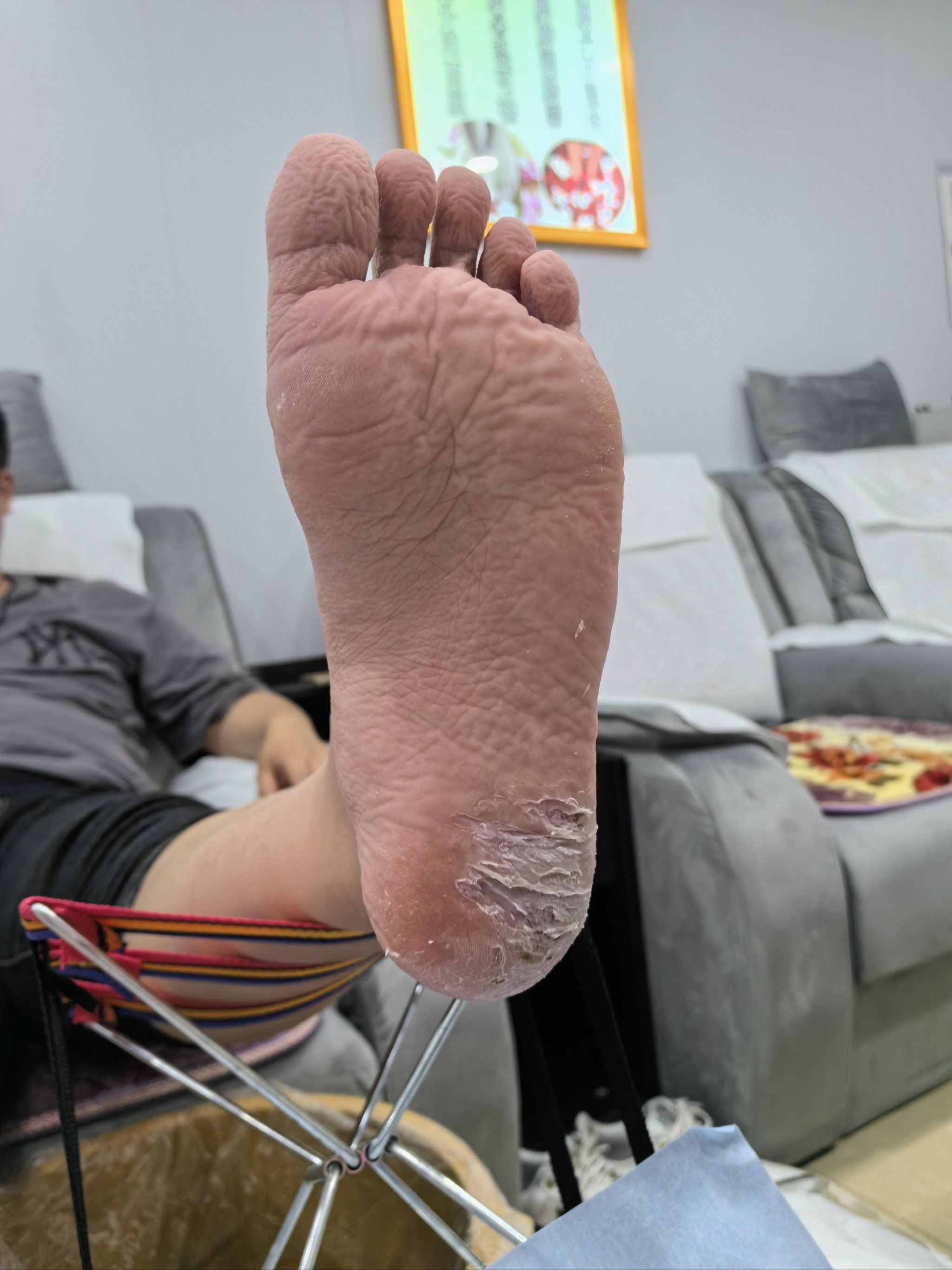 脚癣反反复复已经成这个样子,问了好几家都