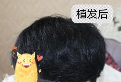 -大麦微针植发全国连锁