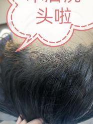 -大麦微针植发全国连锁