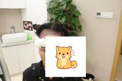 -大麦微针植发丨全国连锁