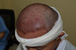 -大麦微针植发丨全国连锁