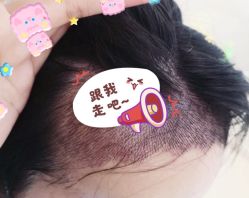 -大麦微针植发全国连锁