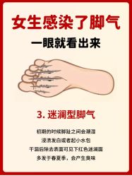 -德哥灰指甲脚气甲沟炎跖疣护理