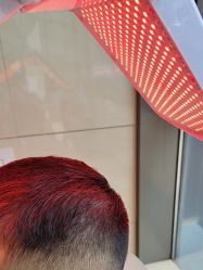 -碧莲盛·不剃发植发