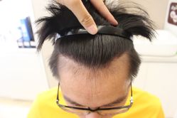 -大麦微针植发丨全国连锁