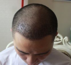 -大麦微针植发丨全国连锁