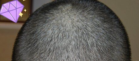 -大麦微针植发丨全国连锁