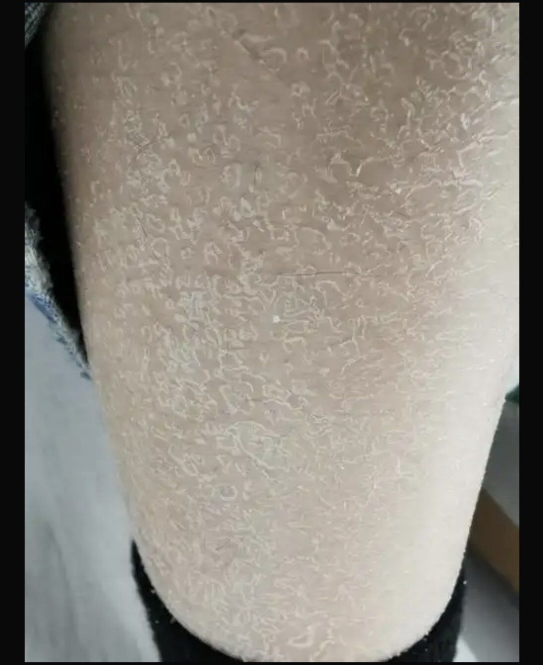冬季是皮肤问题高发期,很多人会出现皮肤干燥,脱屑,瘙痒和裂纹等问题