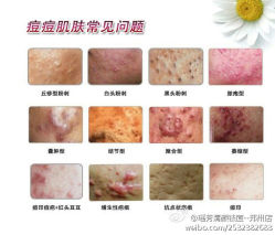 痘痘的分类-宜肤清颜专业祛痘问题肌修护