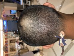 -大麦微针植发丨全国连锁