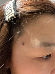 -北京美痣堂古方祛痣斑疣瘊