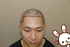 点击看大图 -大麦微针植发丨全国连锁