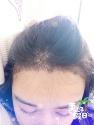 -大麦微针植发全国连锁