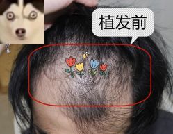 -大麦微针植发全国连锁