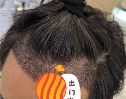 -大麦微针植发全国连锁