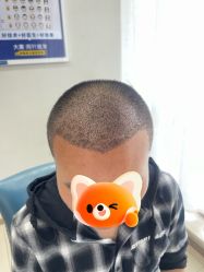 体验后-大麦微针植发丨全国连锁